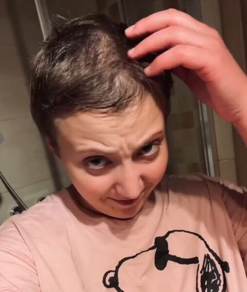 Anička SLováčková ukázala, jak jí potřetí vypadávají vlasy. Foto: IG